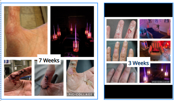 Before-and-after photos showing skin healing progress over 3 and 7 weeks with light therapy